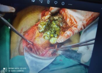 “Medical Triumph: Surgical Team Successfully Removes Multiple Glass Pieces from Patient’s Digestive Tract, Saving His Life”
